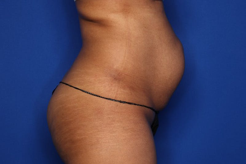 Tummy Tuck Before & After Gallery - Patient 417269 - Image 5