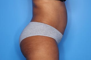 Tummy Tuck Before & After Gallery - Patient 417269 - Image 6