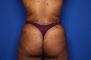 Liposuction Before & After Gallery - Patient 285617 - Image 6