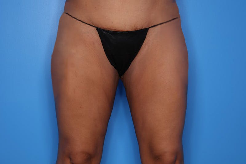 Body Lift Before & After Gallery - Patient 324915 - Image 2