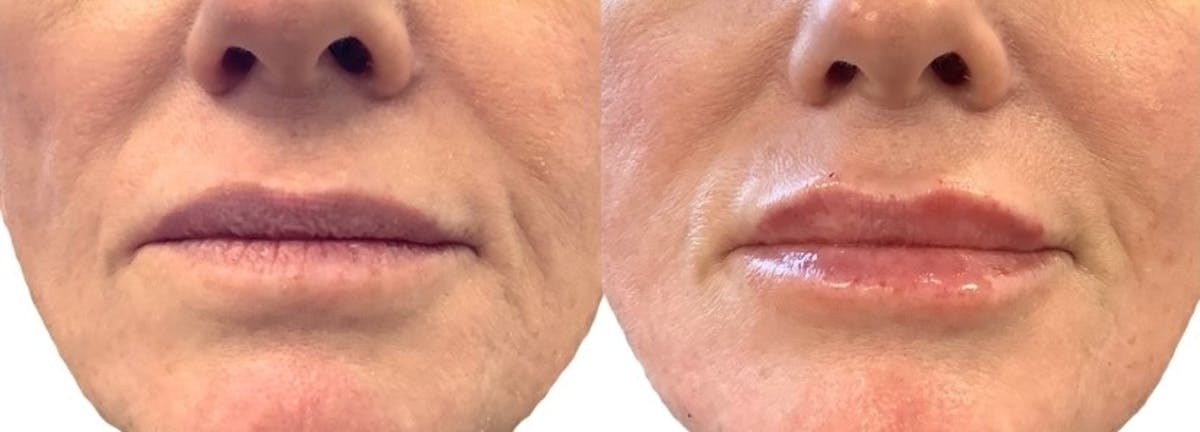 Lip Filler Before & After Gallery - Patient 133864 - Image 1