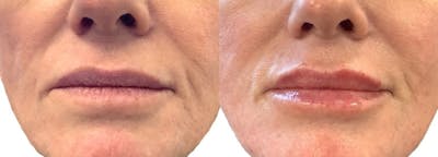 Lip Filler Before & After Gallery - Patient 133864 - Image 1