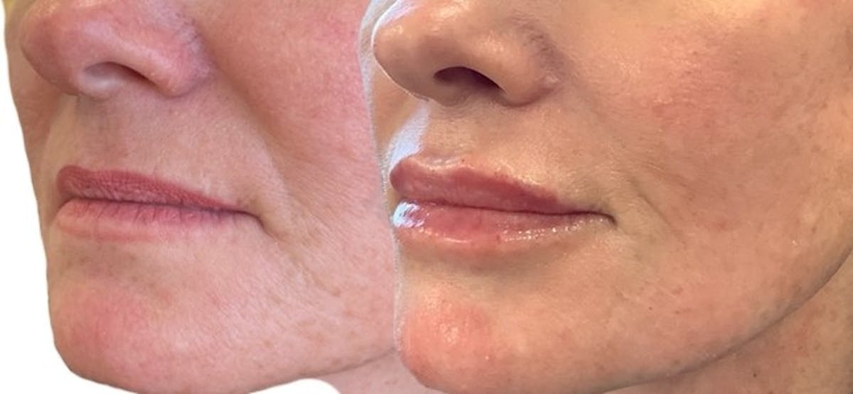 Lip Filler Before & After Gallery - Patient 311704 - Image 1
