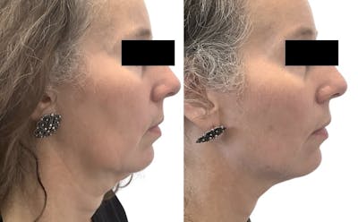 Chin Filler Before & After Gallery - Patient 146139 - Image 1