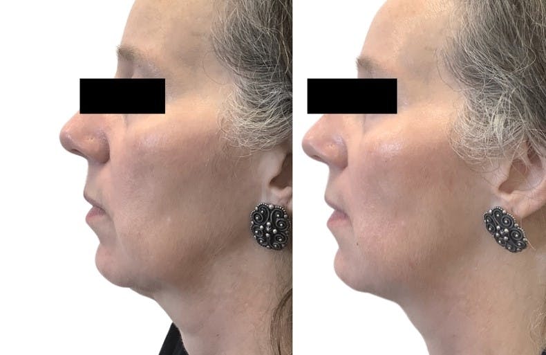 Cheek Filler Before & After Gallery - Patient 219457 - Image 2