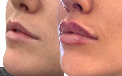 Juvéderm® Before & After Gallery - Patient 180771 - Image 1