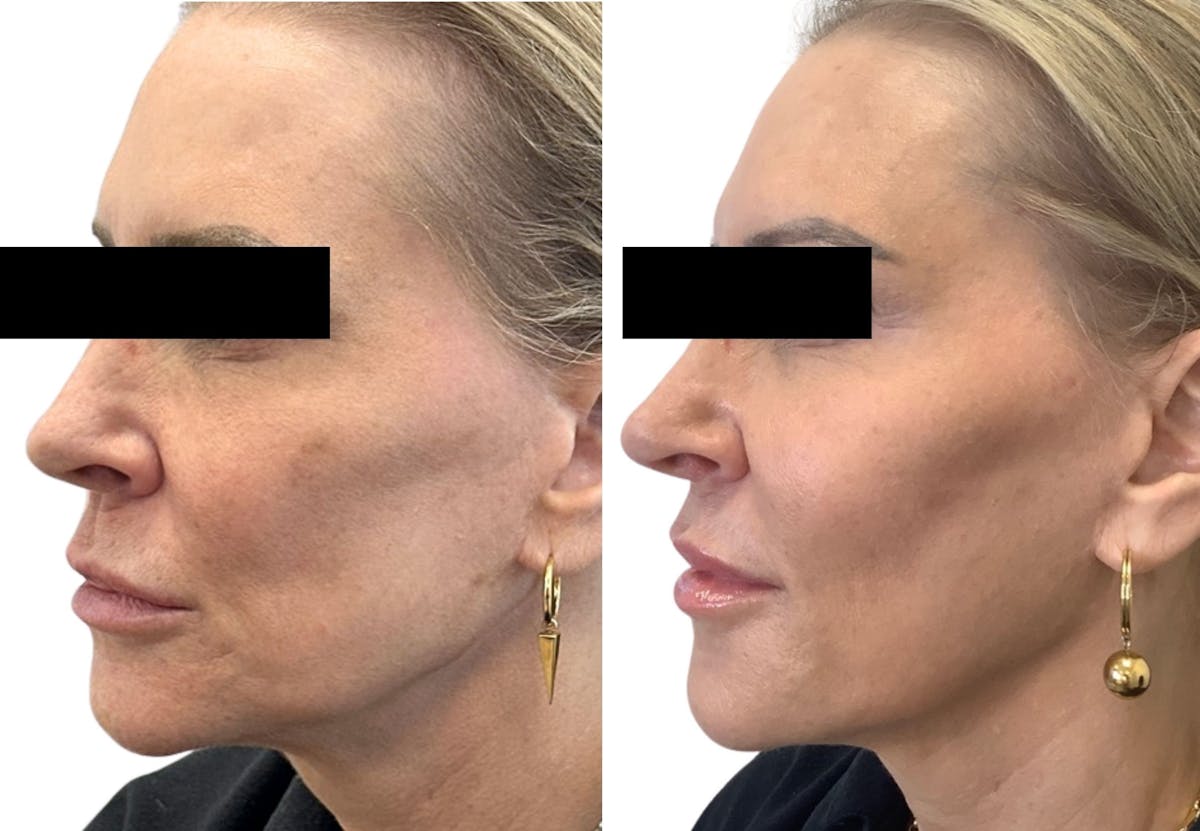 Cheek Filler Before & After Gallery - Patient 768473 - Image 1