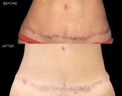 Sciton® Halo Before & After Gallery - Patient 578460 - Image 1