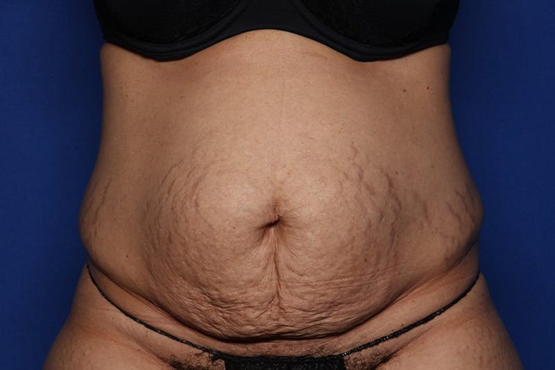 Tummy Tuck Before & After Gallery - Patient 399646 - Image 1