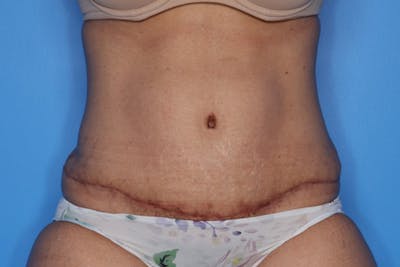 Tummy Tuck Before & After Gallery - Patient 399646 - Image 2