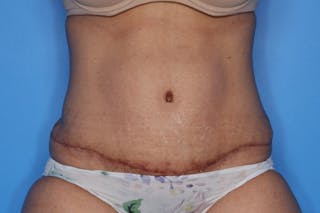 Tummy Tuck Before & After Gallery - Patient 399646 - Image 2