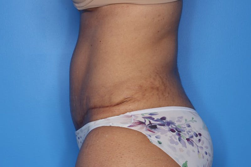 Tummy Tuck Before & After Gallery - Patient 399646 - Image 4