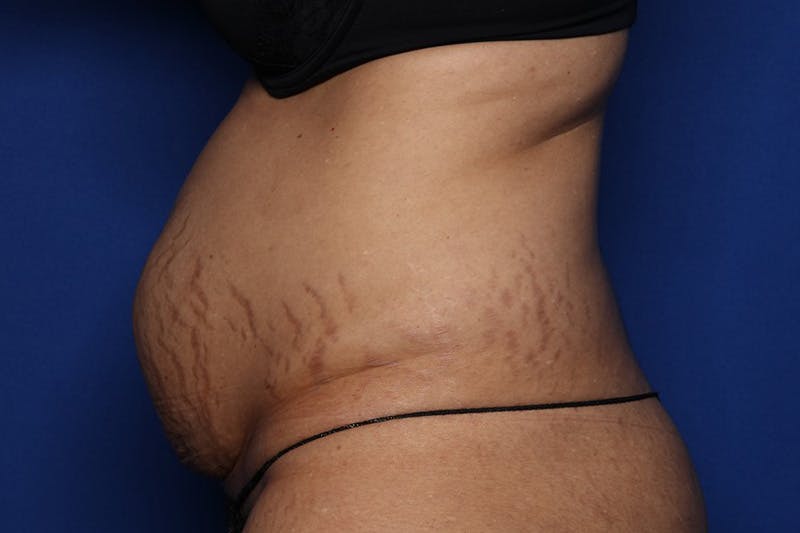 Tummy Tuck Before & After Gallery - Patient 399646 - Image 3
