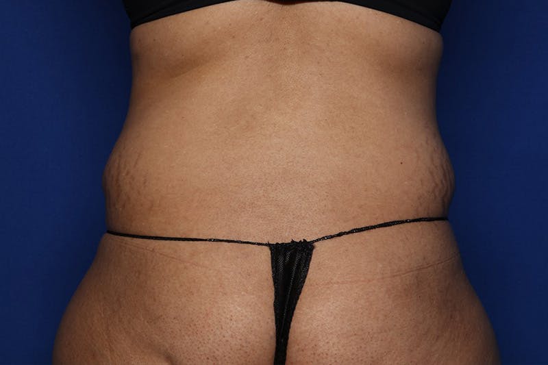 Tummy Tuck Before & After Gallery - Patient 399646 - Image 5