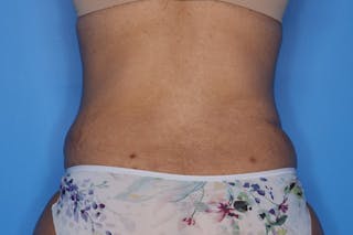 Tummy Tuck Before & After Gallery - Patient 399646 - Image 6