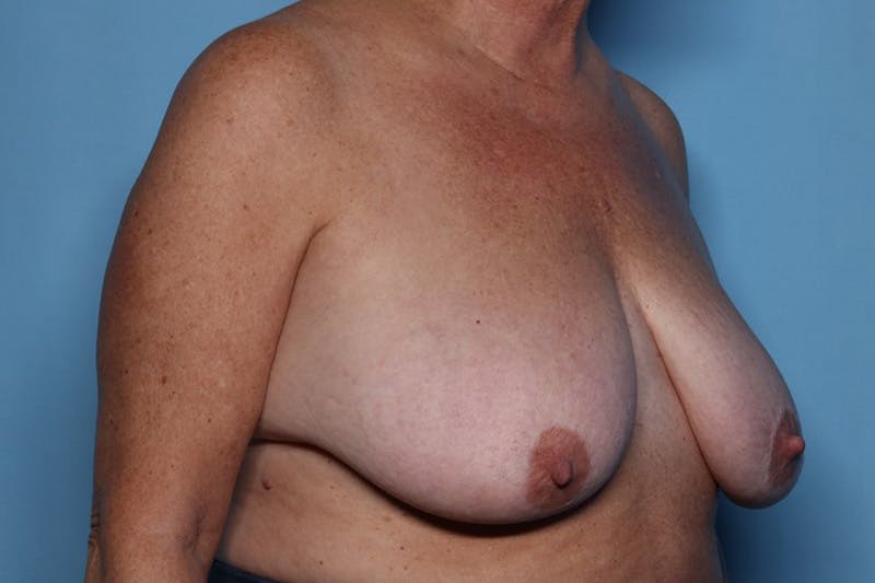 Breast Reduction Before & After Gallery - Patient 239356 - Image 3