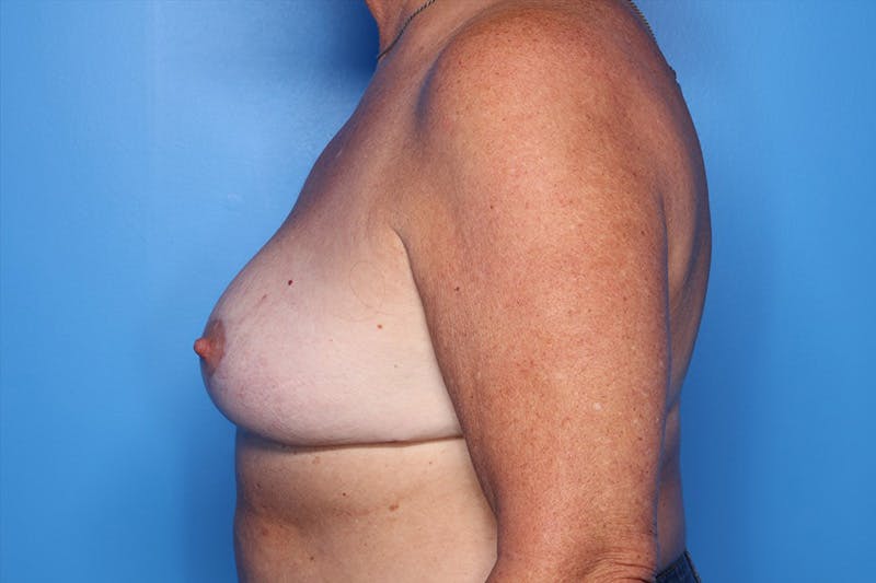 Breast Reduction Before & After Gallery - Patient 239356 - Image 6