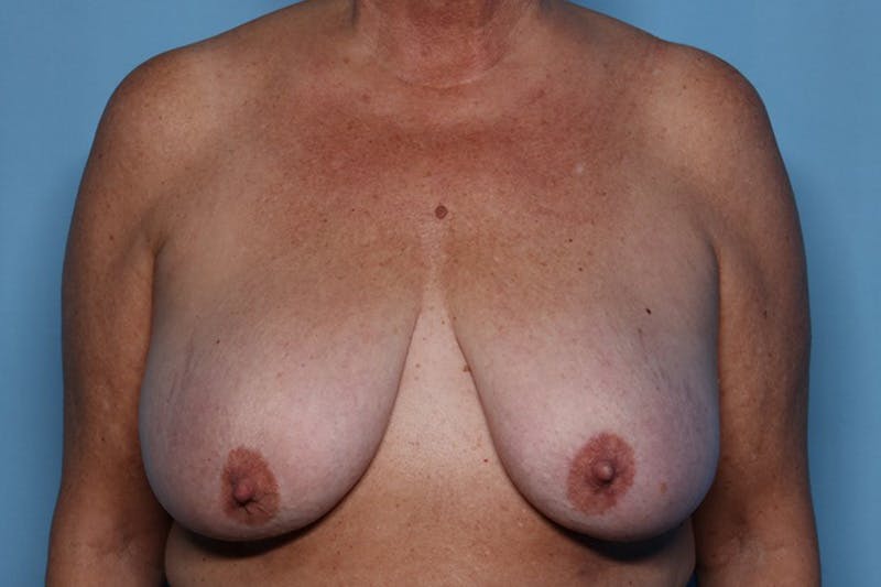 Breast Reduction Before & After Gallery - Patient 239356 - Image 1