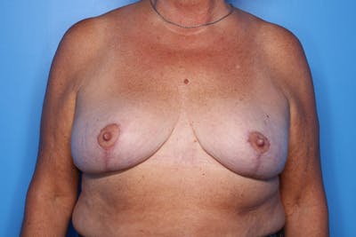 Breast Reduction Before & After Gallery - Patient 239356 - Image 2