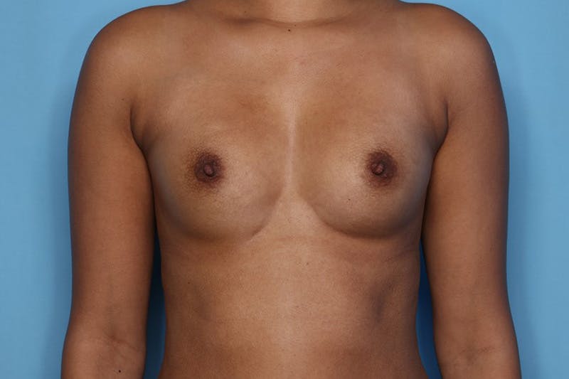 Breast Augmentation Before & After Gallery - Patient 108031 - Image 1
