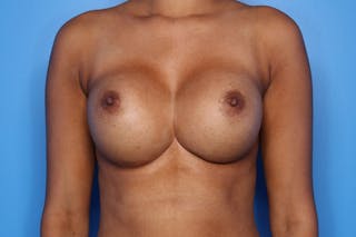 Breast Augmentation Before & After Gallery - Patient 108031 - Image 2