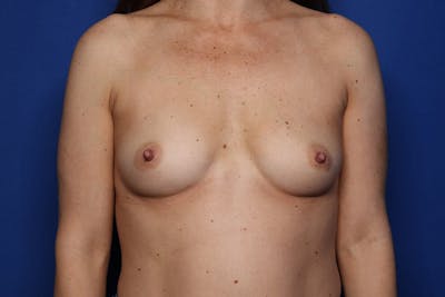 Breast Augmentation Before & After Gallery - Patient 181971 - Image 1