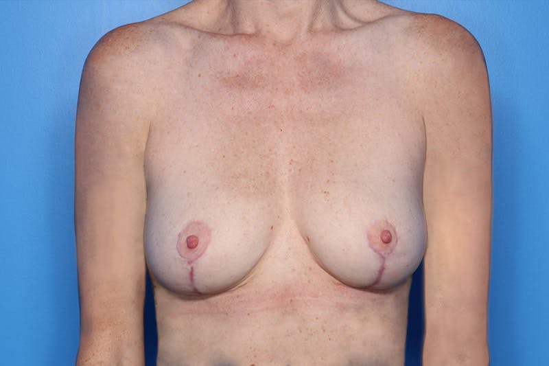 Breast Lift Before & After Gallery - Patient 250945 - Image 2