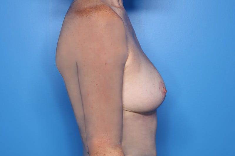 Breast Lift Before & After Gallery - Patient 250945 - Image 4