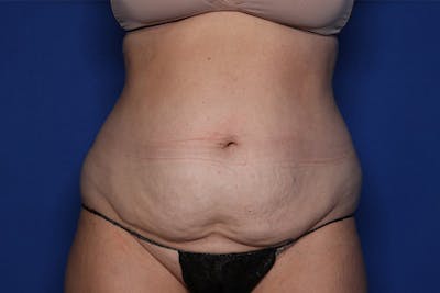 BodyTite™ Before and After Before & After Gallery - Patient 164248 - Image 1