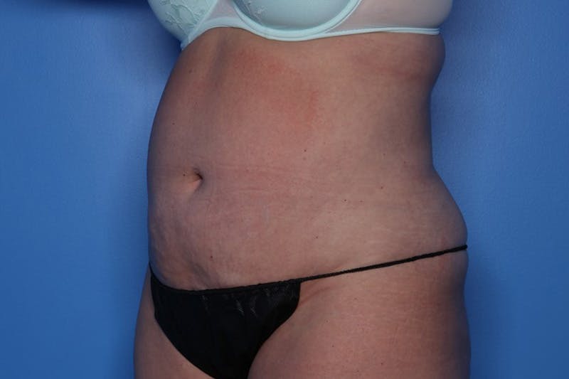 BodyTite™ Before and After Before & After Gallery - Patient 164248 - Image 4