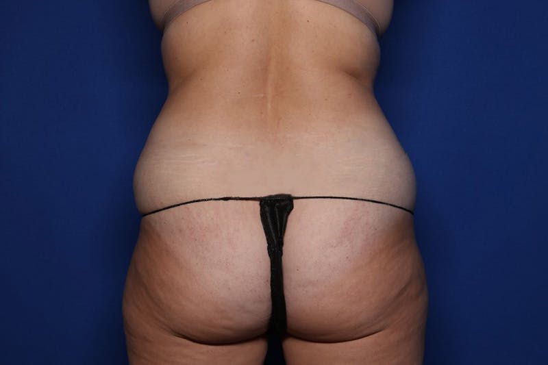 BodyTite™ Before and After Before & After Gallery - Patient 164248 - Image 7