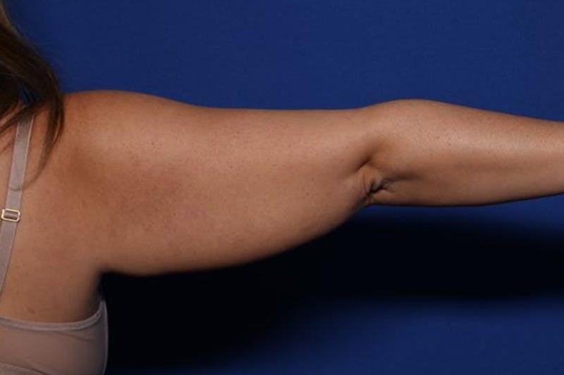 BodyTite™ Before and After Before & After Gallery - Patient 164248 - Image 9