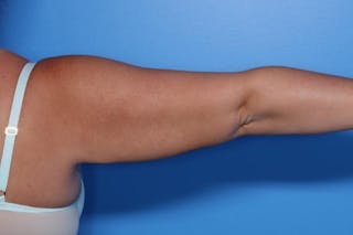 BodyTite™ Before and After Before & After Gallery - Patient 164248 - Image 10