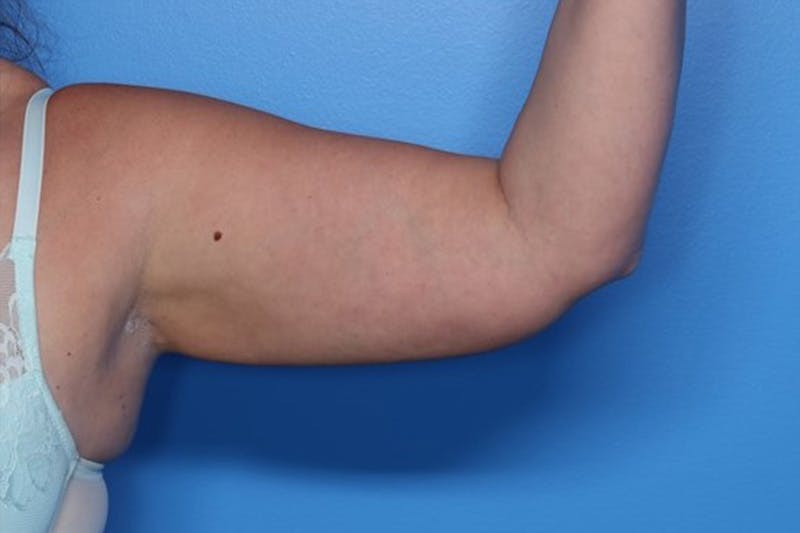 BodyTite™ Before and After Before & After Gallery - Patient 164248 - Image 12