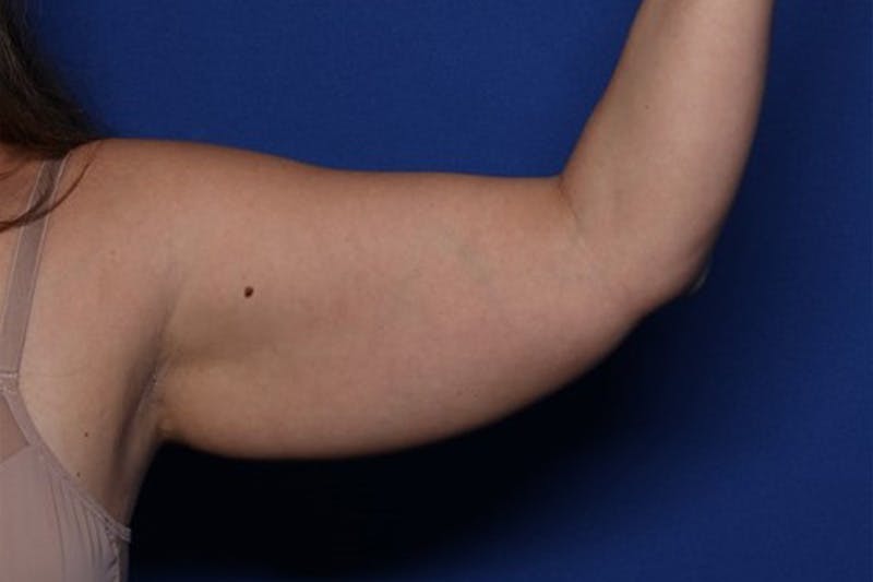 BodyTite™ Before and After Before & After Gallery - Patient 164248 - Image 11