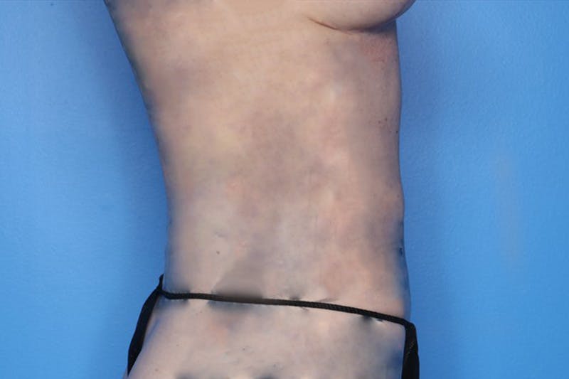 BodyTite™ Before and After Before & After Gallery - Patient 339277 - Image 4