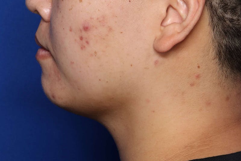 FaceTite Before and After Before & After Gallery - Patient 278531 - Image 2