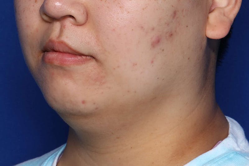 FaceTite Before and After Before & After Gallery - Patient 278531 - Image 3