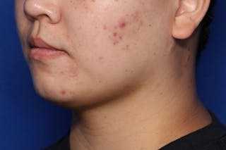 FaceTite Before and After Before & After Gallery - Patient 278531 - Image 4