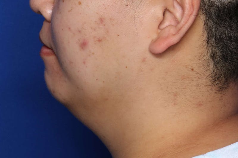 FaceTite Before and After Before & After Gallery - Patient 278531 - Image 1