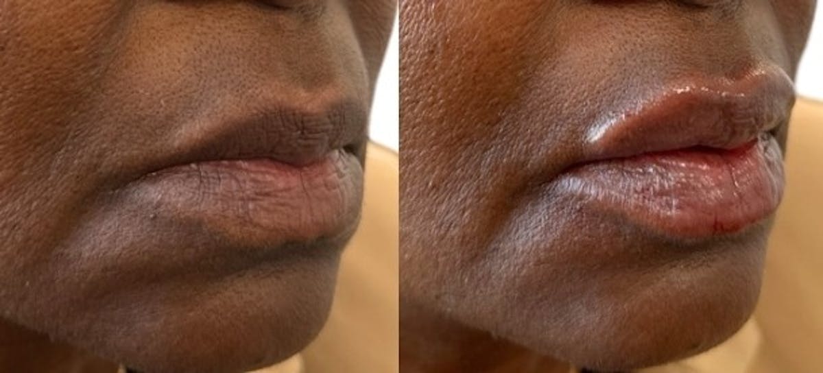 Juvéderm® Before & After Gallery - Patient 370827 - Image 1