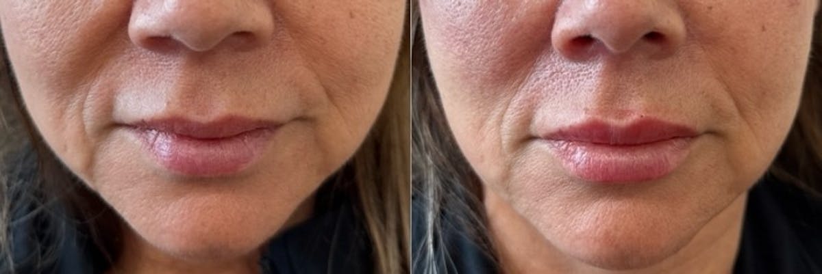 Juvéderm® Before & After Gallery - Patient 246783 - Image 1