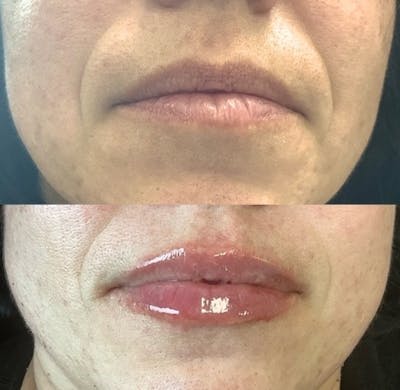 Juvéderm® Before & After Gallery - Patient 223035 - Image 1