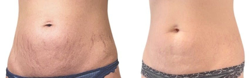 Morpheus8® Before & After Gallery - Patient 348839 - Image 3