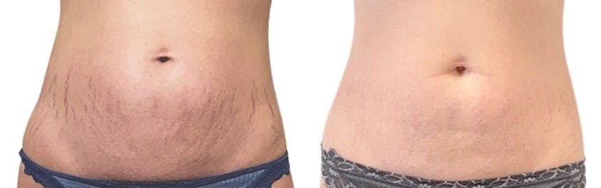 Morpheus8® Before & After Gallery - Patient 348839 - Image 1