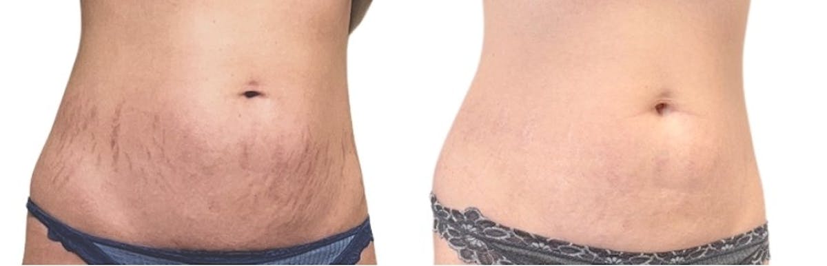 Morpheus8® Before & After Gallery - Patient 348839 - Image 2