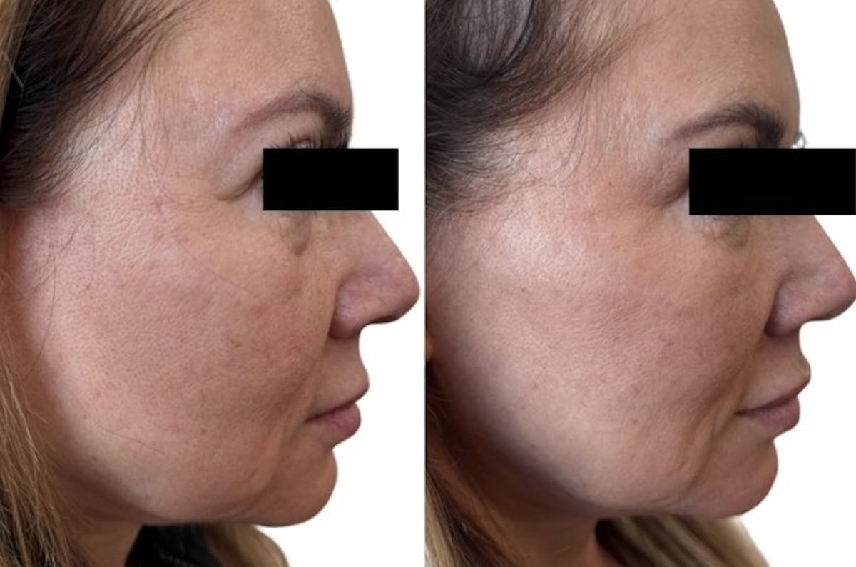 Cheek Filler Before & After Gallery - Patient 471615 - Image 2
