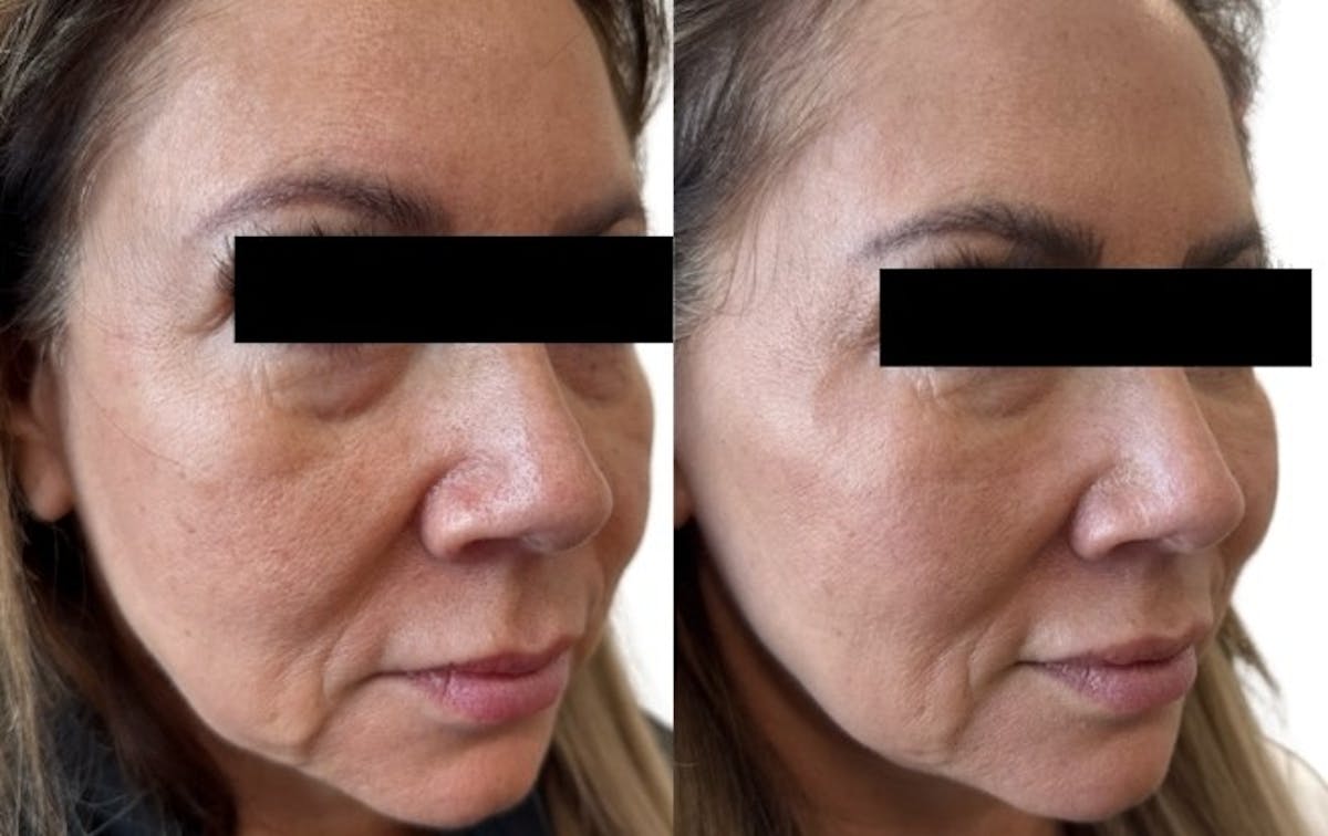 Cheek Filler Before & After Gallery - Patient 471615 - Image 1