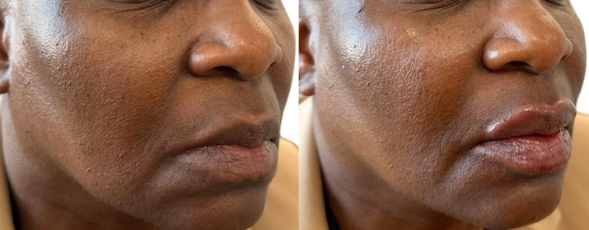 Juvéderm® Before & After Gallery - Patient 322251 - Image 1
