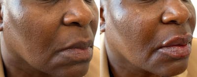 Juvéderm® Before & After Gallery - Patient 322251 - Image 1